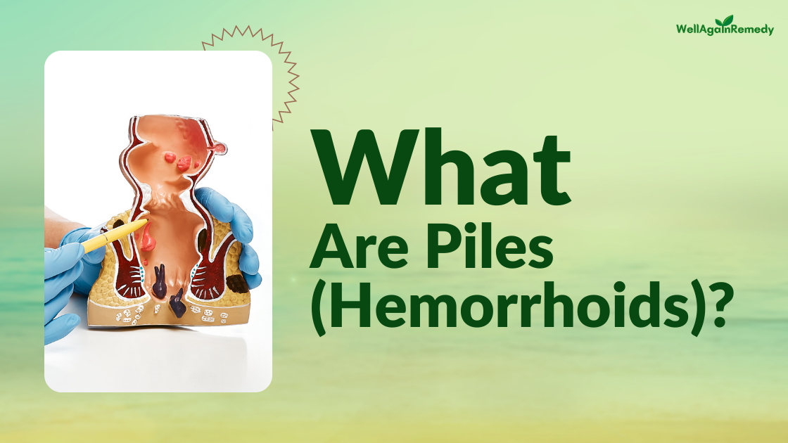 What Are Piles (Hemorrhoids)?