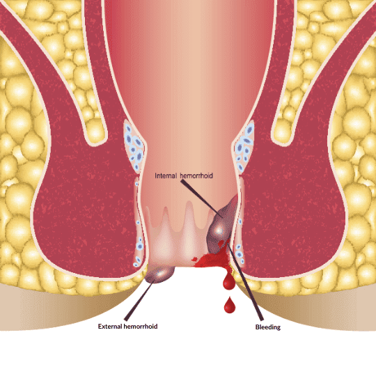 what are piles (hemorrhoids)?